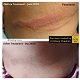 Psoriasis_case_before_after