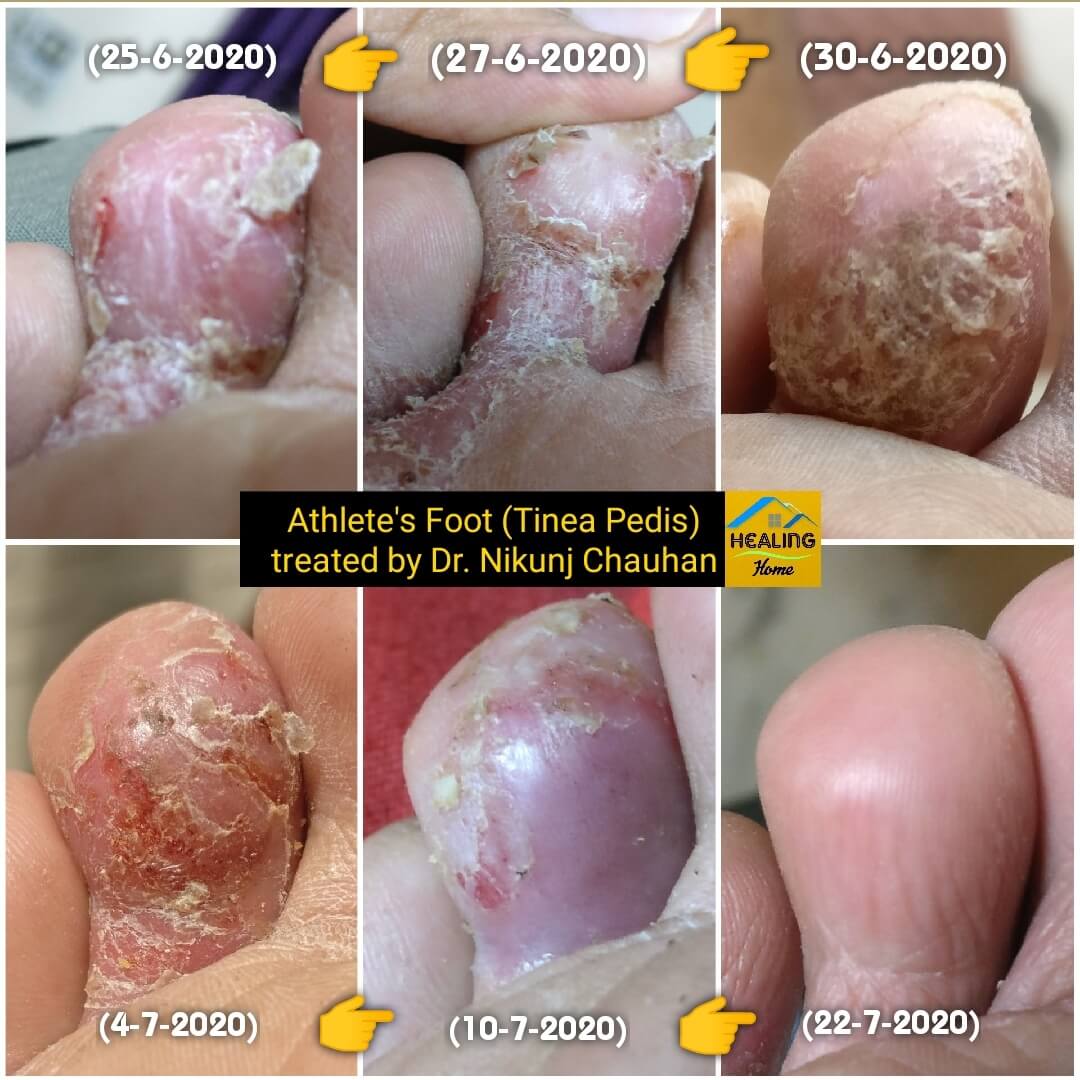 Tinea Pedis problem